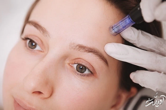 تکنیک میکرونیدلینگ